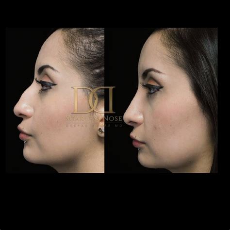 deepak dugar reviews|dr dugar rhinoplasty cost.